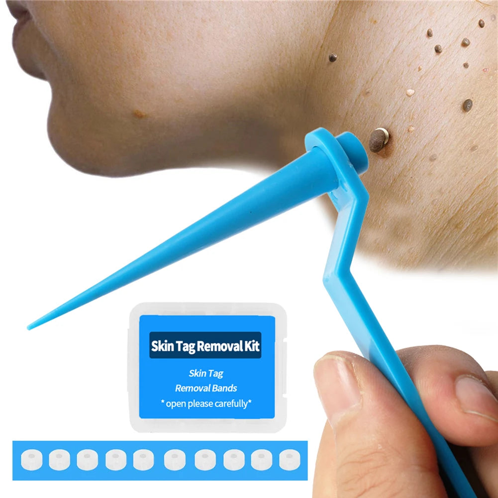 Skin Tag Remover Device for Large Mole Wart Removal