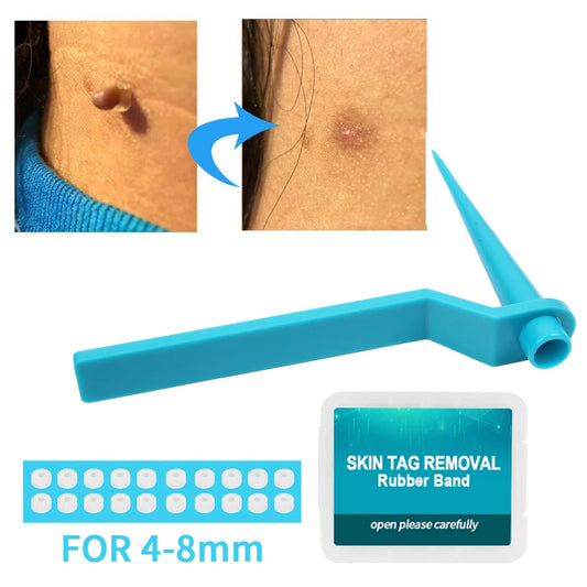 Skin Tag Remover Device for Large Mole Wart Removal
