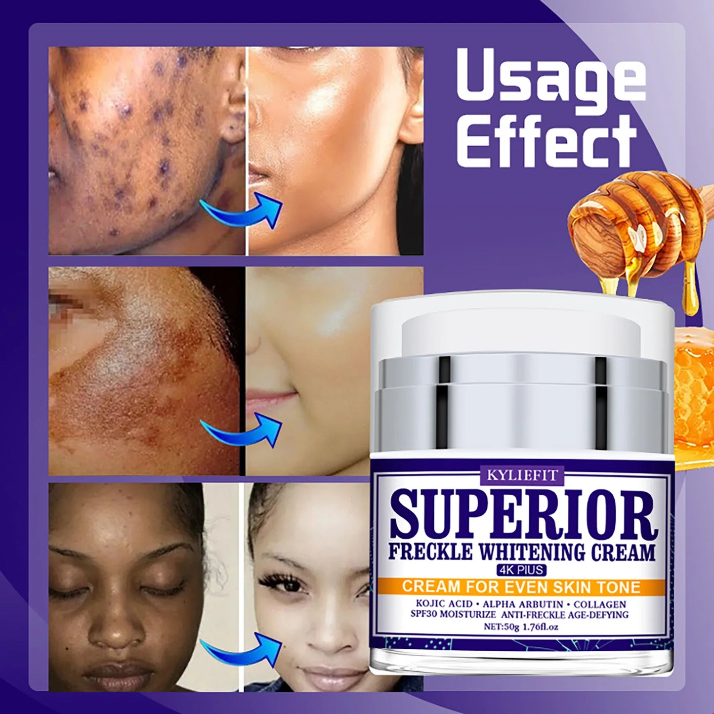 KYLIEFIT Dark Spot Remover for Face, Hyperpigmentation, Melasma, Freckle, Sun Spots Removal, Whitening Cream for Women and Men