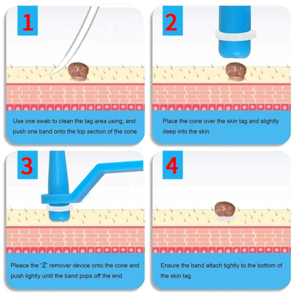 Skin Tag Remover Device for Large Mole Wart Removal