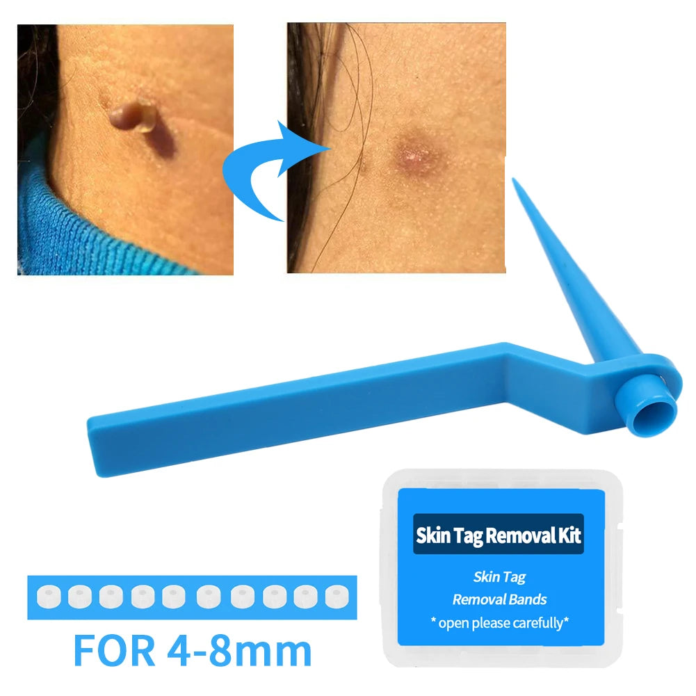 Skin Tag Remover Device for Large Mole Wart Removal